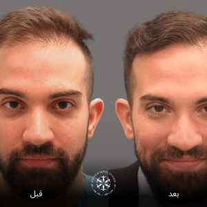 زراعة الشعر الرياض