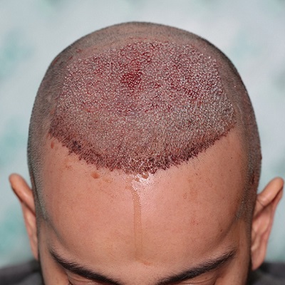 تكلفة زراعة الشعر بـ 4000 أو 5000 طعم في الرياض