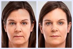 علاج الميزوثيرابي في الرياض