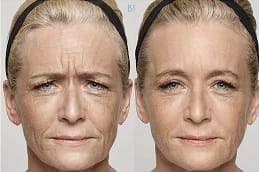 الحشوات الجلدية في الرياض