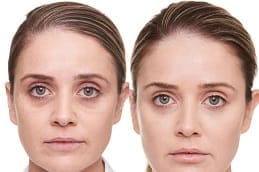 العلاج الحشوات الجلدية في الرياض