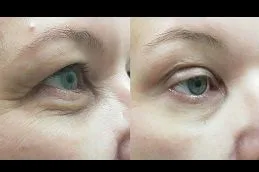 تكلفة حقن الفيلر تحت العين