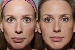 تكلفة سكلبترا فيلر