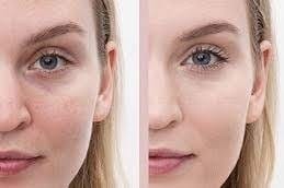 حقن الفيلر تحت العين