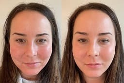 سعر سكولبترا فيلر