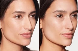 علاج سكلبترا فيلر