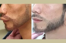 زراعة شعر الشارب قبل وبعد