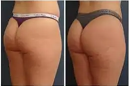 عملية تجميل المؤخرة الفرنسية قبل وبعد