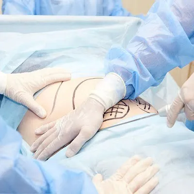 كم مقدار الوزن الذي ستفقده مع عملية شفط الدهون في الرياض