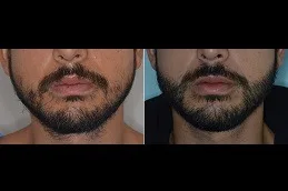 نتائج زراعة شعر الشارب قبل وبعد