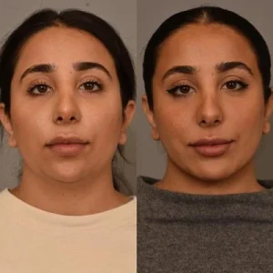 صور قبل وبعد تكبير الذقن