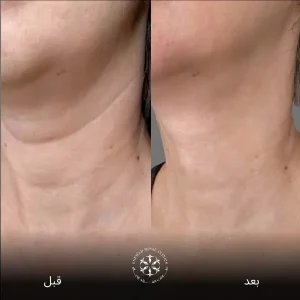فينوس ليجاسي قبل وبعدنتائج
