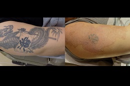Best laser-tattoo-removal in Riyadh & Saudi Arabia