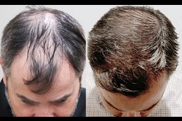 hair-restoration Clinic in Riyadh & Saudi Arabia
