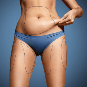 Liposuction Cost in Riyadh Saudi Arabia