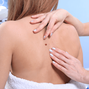 Mole Removal Cost in Riyadh, Saudi Arabia