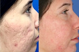 Best acne scar treatment in Saudi Arabia