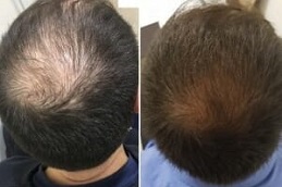 Best baldness treatment for males in Riyadh & Saudi Arabia