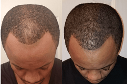 Best baldness treatment for males in Saudi Arabia