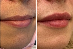 Best russian lip fillers Clinic in Saudi Arabia & Riyadh