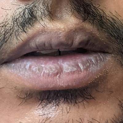 Smoker's Lips Treatment in Riyadh, Jeddah & Saudi Arabia Cost
