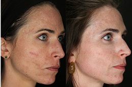 acne scar treatment Riyadh & Saudi Arabia