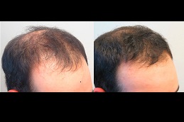 baldness treatment for males Clinic in Riyadh & Saudi Arabia