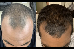 baldness treatment for males in Saudi Arabia