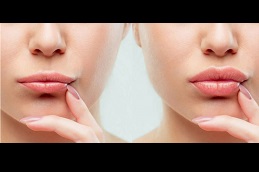 russian lip fillers Clinic in Riyadh & Saudi Arabia