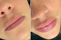 russian lip fillers in Saudi Arabia