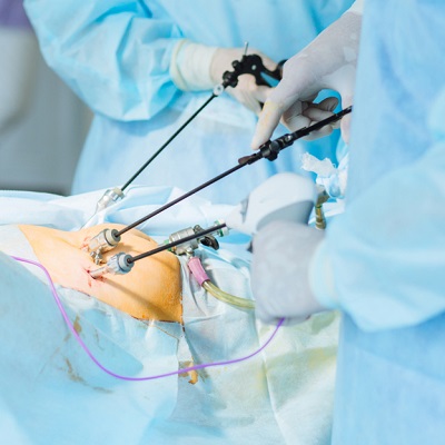 Best Laparoscopic Surgery in Riyadh & Saudi Arabia Laparoscopic Cost