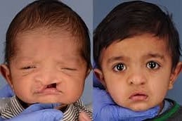 Best Congenital Anomalies Riyadh