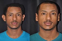 Best Ear Reshaping Riyadh