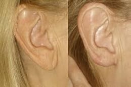 Best Earlobe Correction Surgery in Riyadh
