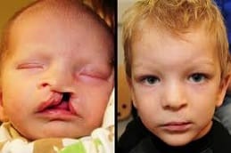 Congenital Anomalies in Riyadh