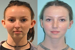 Ear Reshaping Cost in Riyadh