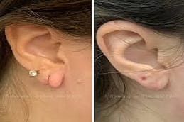 Earlobe Correction Surgery Clinic in Riyadh