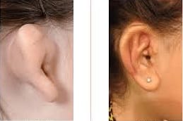 Earlobe Correction Surgery in Riyadh
