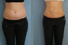 Best Fat transfer Surgery In Riyadh