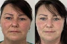 Best HIFU Treatment Riyadh