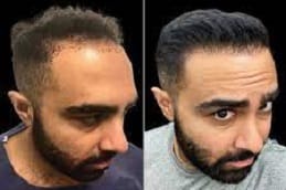 Best Hair Transplant Cost Riyadh