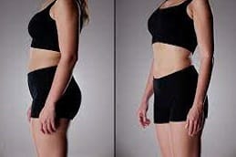 Best Laser Lipolysis Treatment Riyadh