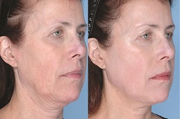 Best Microdermabrasion with Ultrasound Riyadh