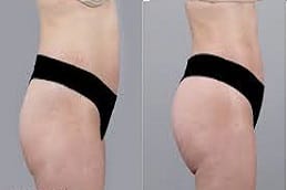 Fat transfer Surgery Clinic In Riyadh