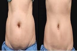 Fat transfer Surgery Cost In Riyadh