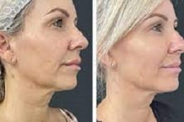 HIFU Treatment Cost In Riyadh