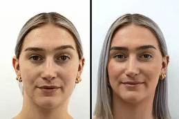 HIFU Treatment in Riyadh