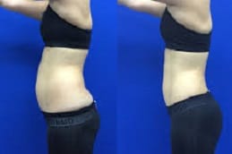 Laser Lipolysis Treatment Clinic In Riyadh