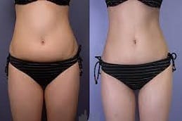 Laser Lipolysis Treatment in Riyadh