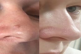 Skin Tag Removal Clinic In Riyadh